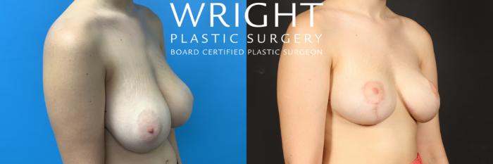 Before & After Breast Reduction Case 502 Right Oblique View in Little Rock, Arkansas