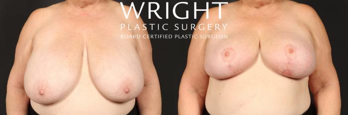 Before & After Breast Reduction Case 511 Front View in Little Rock, Arkansas