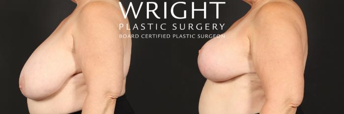 Before & After Breast Reduction Case 511 Left Side View in Little Rock, Arkansas