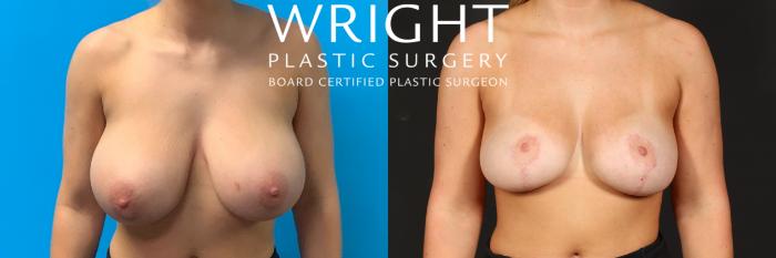 Before & After Breast Reduction Case 517 Front View in Little Rock, Arkansas