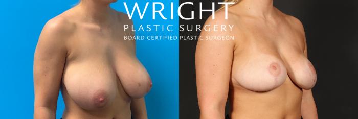 Before & After Breast Reduction Case 517 Right Oblique View in Little Rock, Arkansas