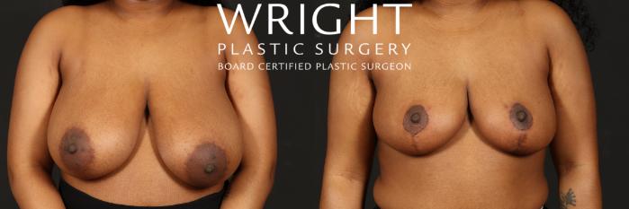 Before & After Breast Reduction Case 522 Front View in Little Rock, Arkansas