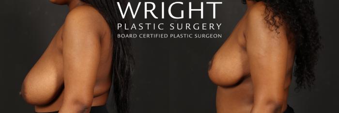 Before & After Breast Reduction Case 522 Left Side View in Little Rock, Arkansas