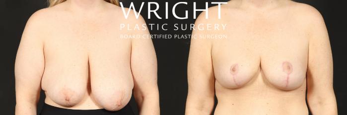 Before & After Breast Reduction Case 541 Front View in Little Rock, Arkansas