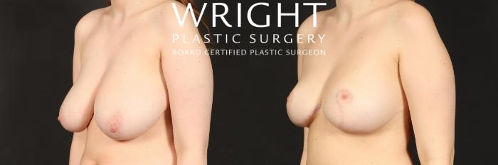 Before & After Breast Reduction Case 566 Left Oblique View in Little Rock, Arkansas