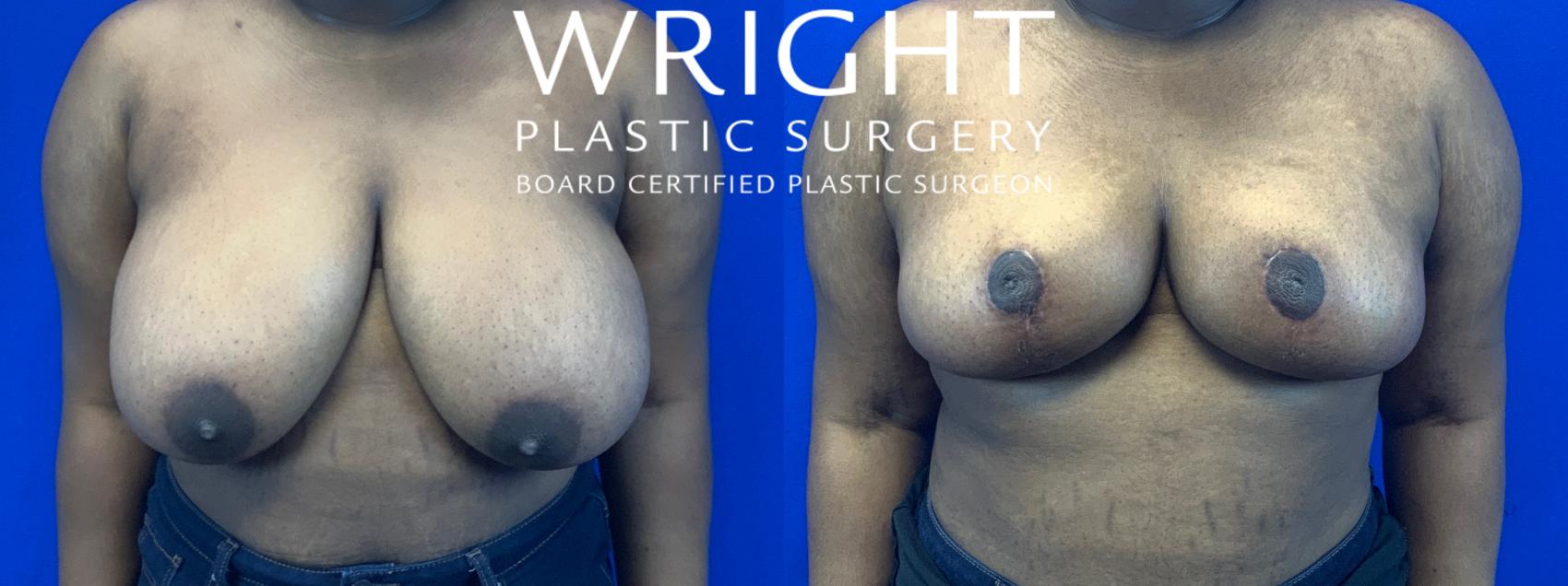 Before & After Breast Reduction Case 60 View 1 View in Little Rock, Arkansas