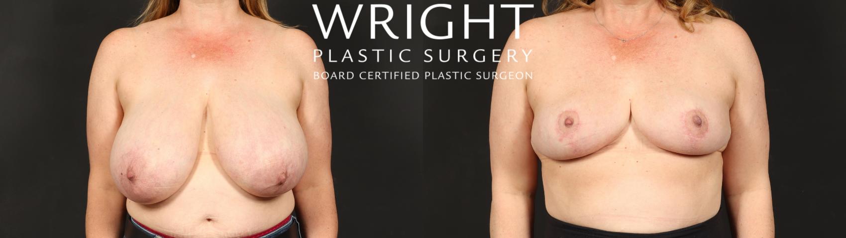 Before & After Breast Reduction Case 612 Front View in Little Rock, Arkansas