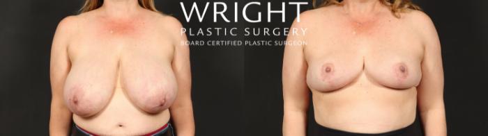 Before & After Breast Reduction Case 612 Front View in Little Rock, Arkansas