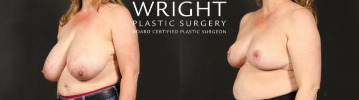 Before & After Breast Reduction Case 612 Left Oblique View in Little Rock, Arkansas