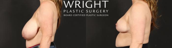 Before & After Breast Reduction Case 612 Left Side View in Little Rock, Arkansas