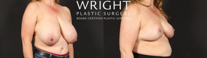 Before & After Breast Reduction Case 612 Right Oblique View in Little Rock, Arkansas