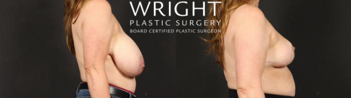 Before & After Breast Reduction Case 612 Right Side View in Little Rock, Arkansas