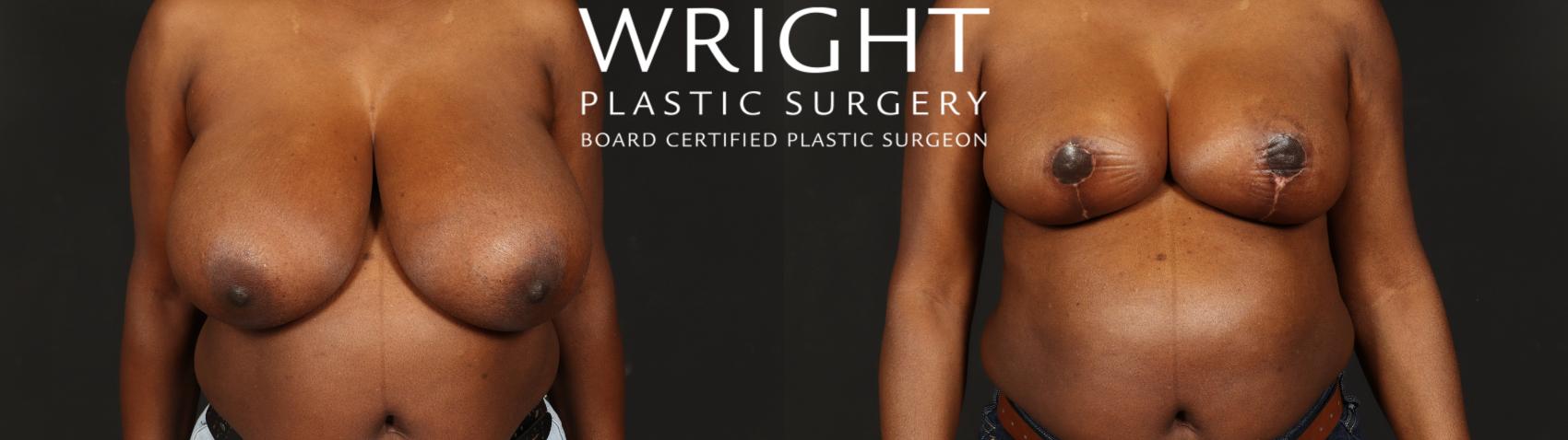 Before & After Breast Reduction Case 648 Front View in Little Rock, Arkansas