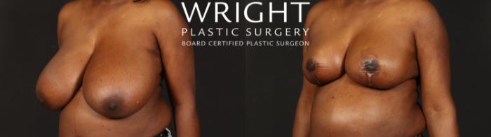 Before & After Breast Reduction Case 648 Left Oblique View in Little Rock, Arkansas