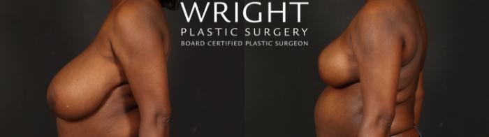 Before & After Breast Reduction Case 648 Left Side View in Little Rock, Arkansas