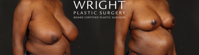 Before & After Breast Reduction Case 648 Right Oblique View in Little Rock, Arkansas