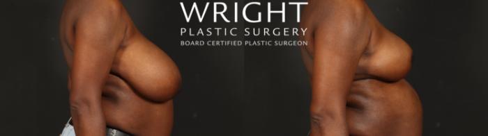 Before & After Breast Reduction Case 648 Right Side View in Little Rock, Arkansas