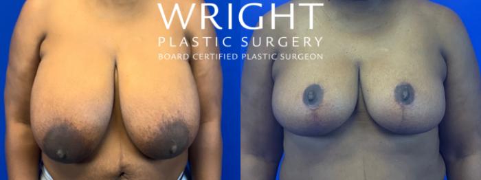 Before & After Breast Reduction Case 65 Front View in Little Rock, Arkansas