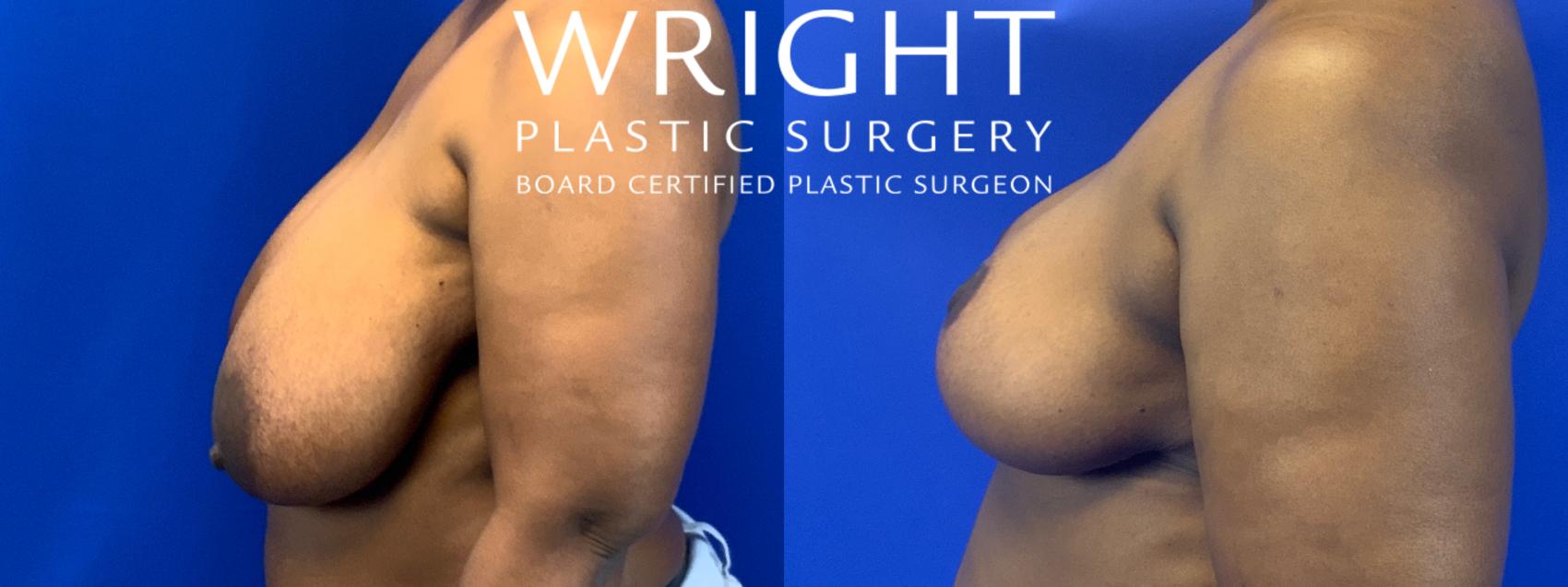 Before & After Breast Reduction Case 65 Left Side View in Little Rock, Arkansas