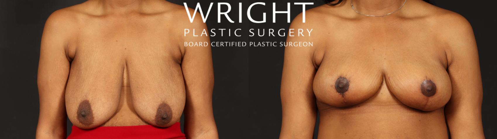 Before & After Breast Reduction Case 655 Front View in Little Rock, Arkansas