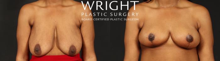 Before & After Breast Reduction Case 655 Front View in Little Rock, Arkansas