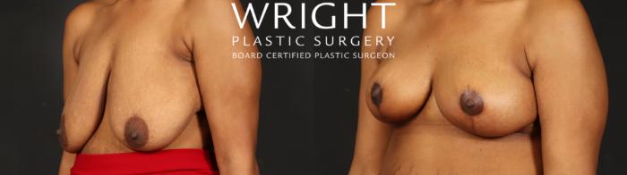 Before & After Breast Reduction Case 655 Left Oblique View in Little Rock, Arkansas
