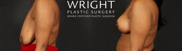 Before & After Breast Reduction Case 655 Left Side View in Little Rock, Arkansas