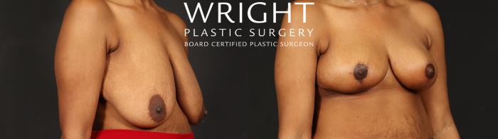 Before & After Breast Reduction Case 655 Right Oblique View in Little Rock, Arkansas