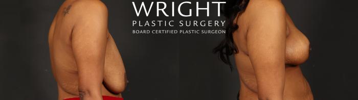Before & After Breast Reduction Case 655 Right Side View in Little Rock, Arkansas