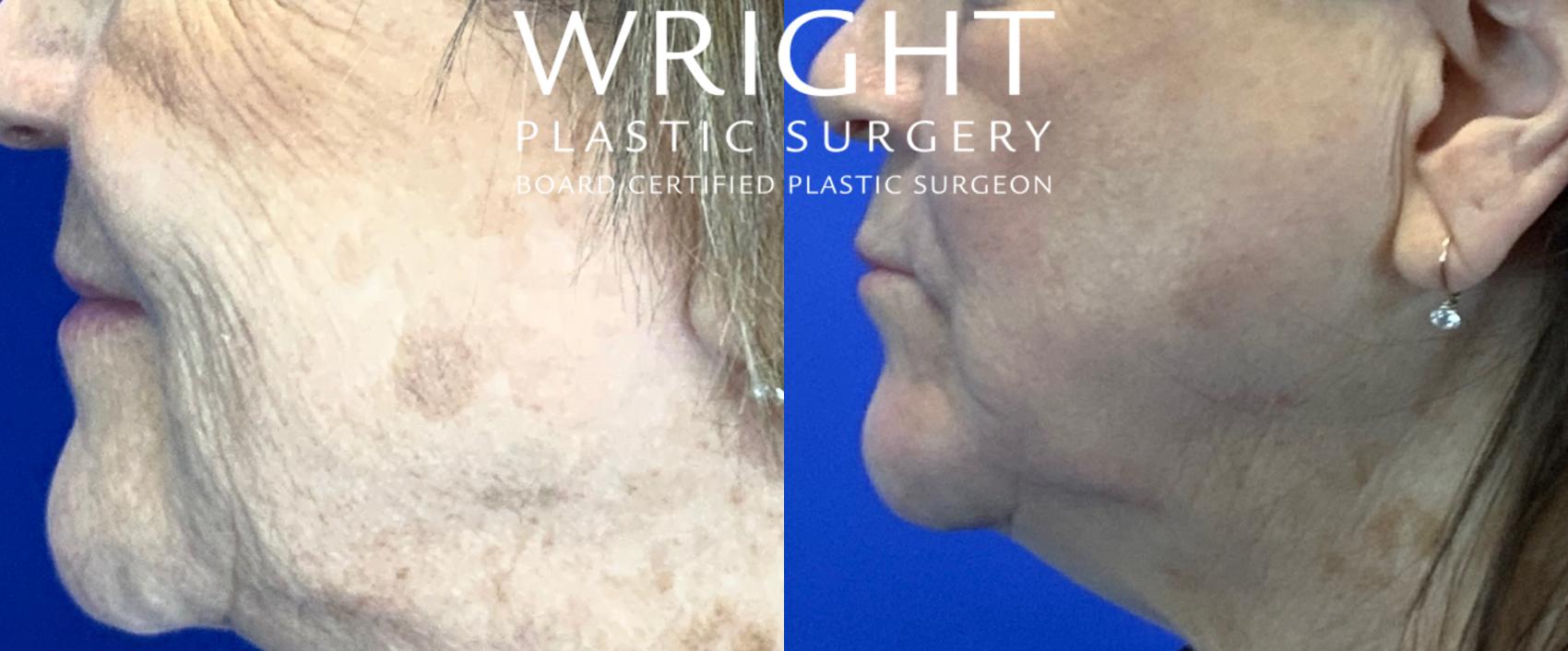 Before & After Chemical Peel Case 71 Left Side View in Little Rock, Arkansas