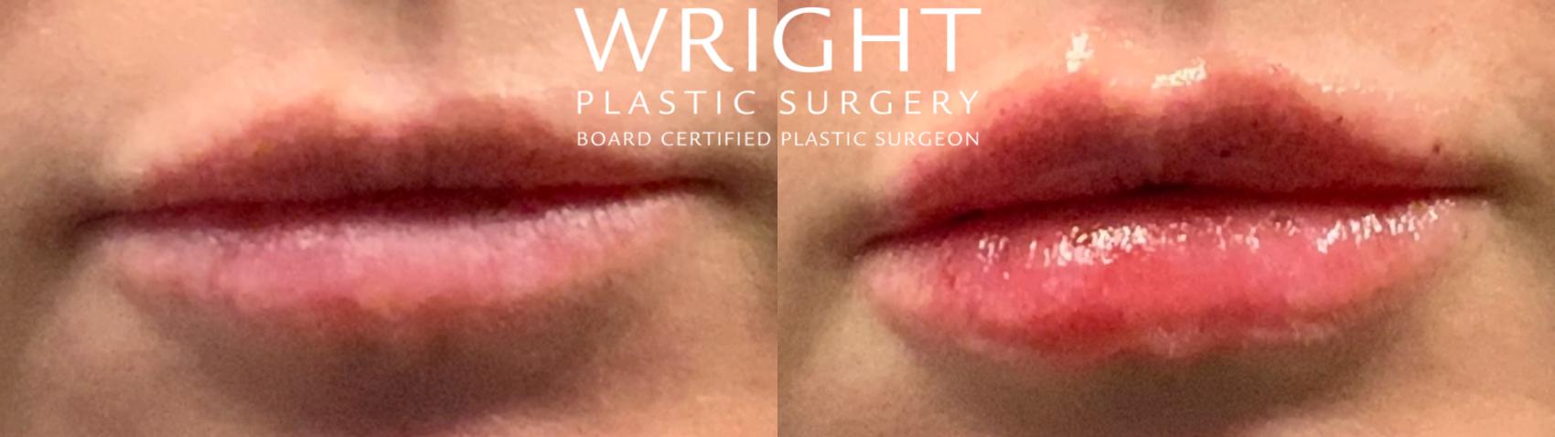 Before & After Dermal Filler Case 113 Front View in Little Rock, Arkansas