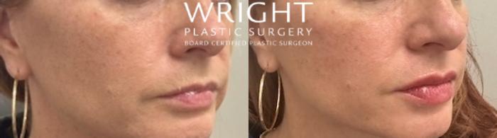 Before & After Dermal Filler Case 526 Right Side View in Little Rock, Arkansas