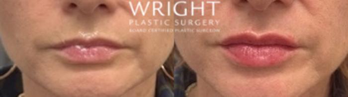 Before & After Dermal Filler Case 527 Front View in Little Rock, Arkansas