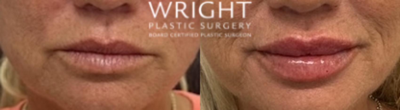 Before & After Dermal Filler Case 529 Front View in Little Rock, Arkansas