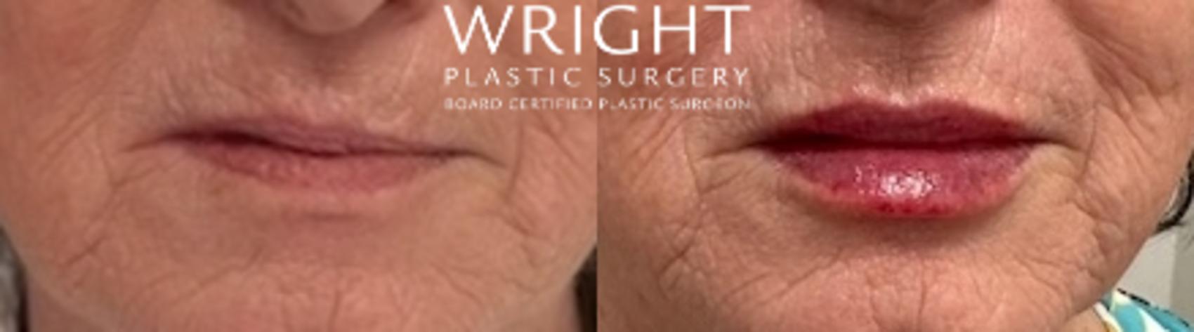 Before & After Dermal Filler Case 530 Front View in Little Rock, Arkansas