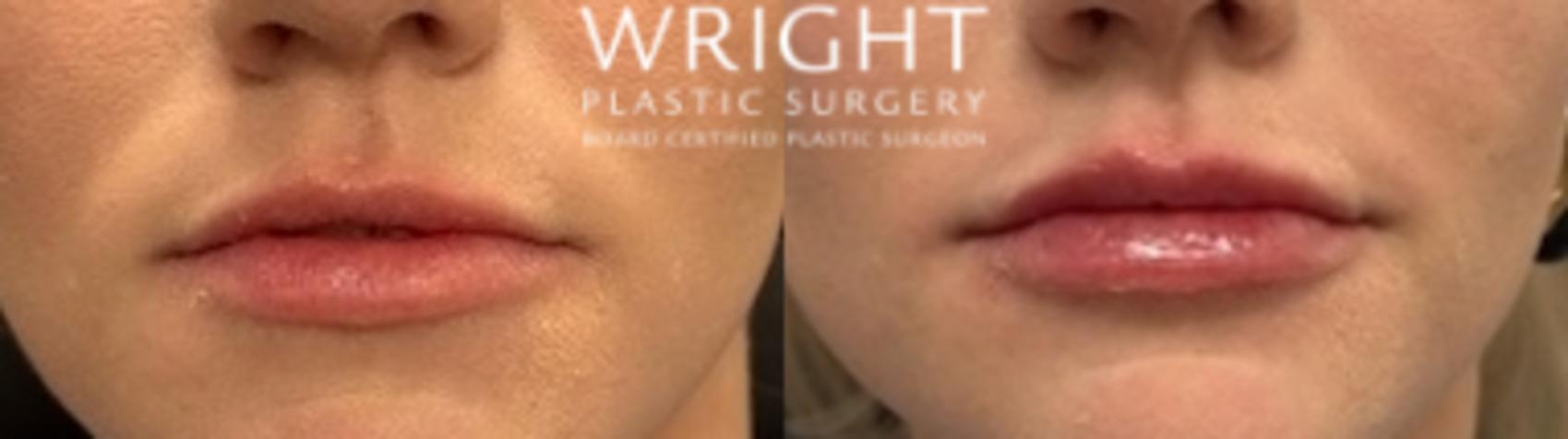 Before & After Dermal Filler Case 533 Front View in Little Rock, Arkansas