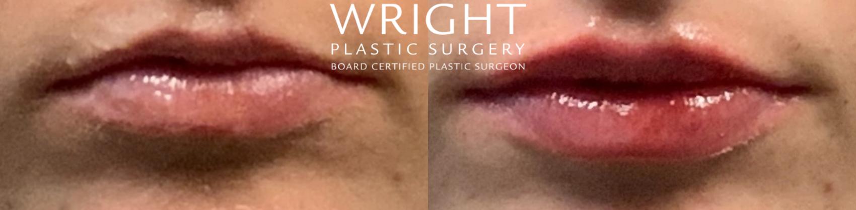 Before & After Dermal Filler Case 76 Front View in Little Rock, Arkansas