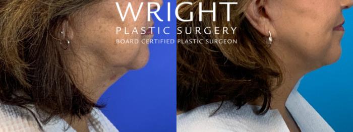 Before & After Facelift Case 175 Right Side View in Little Rock, Arkansas