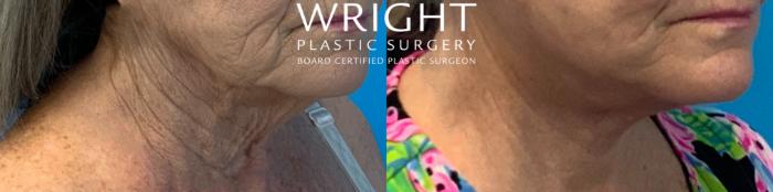 Before & After Facelift Case 397 Right Oblique View in Little Rock, Arkansas