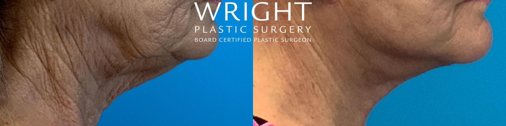 Before & After Facelift Case 397 Right Side View in Little Rock, Arkansas