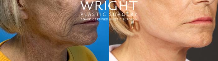 Before & After Facelift Case 485 Right Oblique View in Little Rock, Arkansas