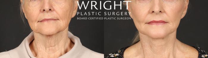 Before & After Facelift Case 642 Front View in Little Rock, Arkansas