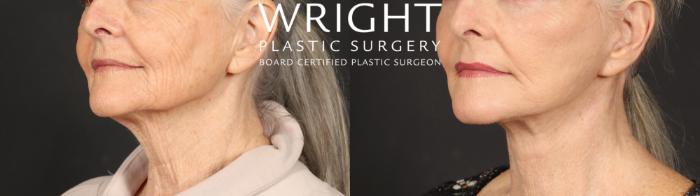 Before & After Facelift Case 642 Left Oblique View in Little Rock, Arkansas