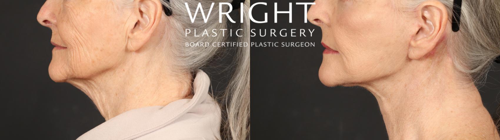 Before & After Facelift Case 642 Left Side View in Little Rock, Arkansas
