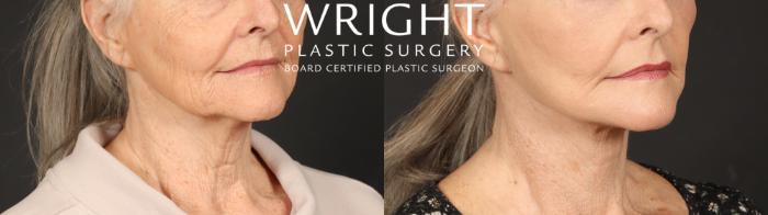 Before & After Facelift Case 642 Right Oblique View in Little Rock, Arkansas