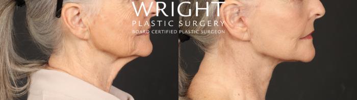 Before & After Facelift Case 642 Right Side View in Little Rock, Arkansas