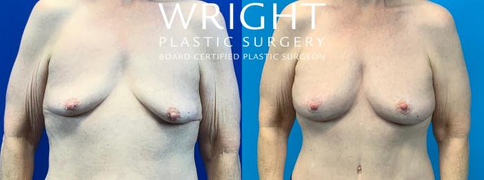 Before & After Breast Lift Case 112 Front View in Little Rock, Arkansas