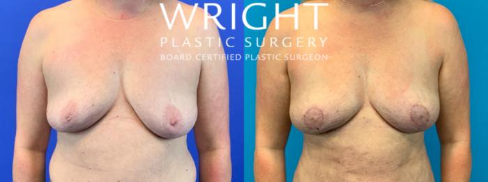 Before & After Breast Lift Case 158 Front View in Little Rock, Arkansas