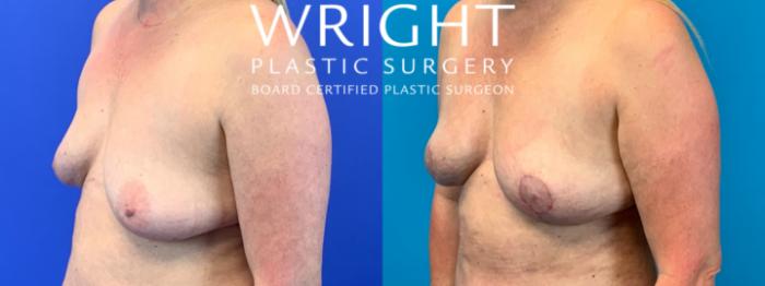 Before & After Breast Lift Case 158 Left Oblique View in Little Rock, Arkansas