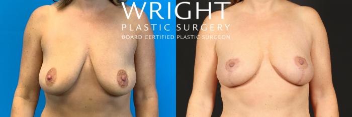 Before & After Breast Lift Case 461 Front View in Little Rock, Arkansas